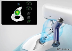 Precision Placement of Knee Replacements