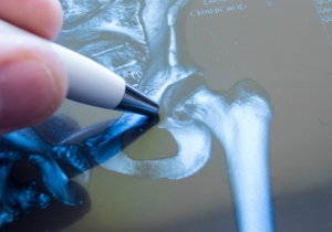 The SPAIRE Posterior Mini Approach